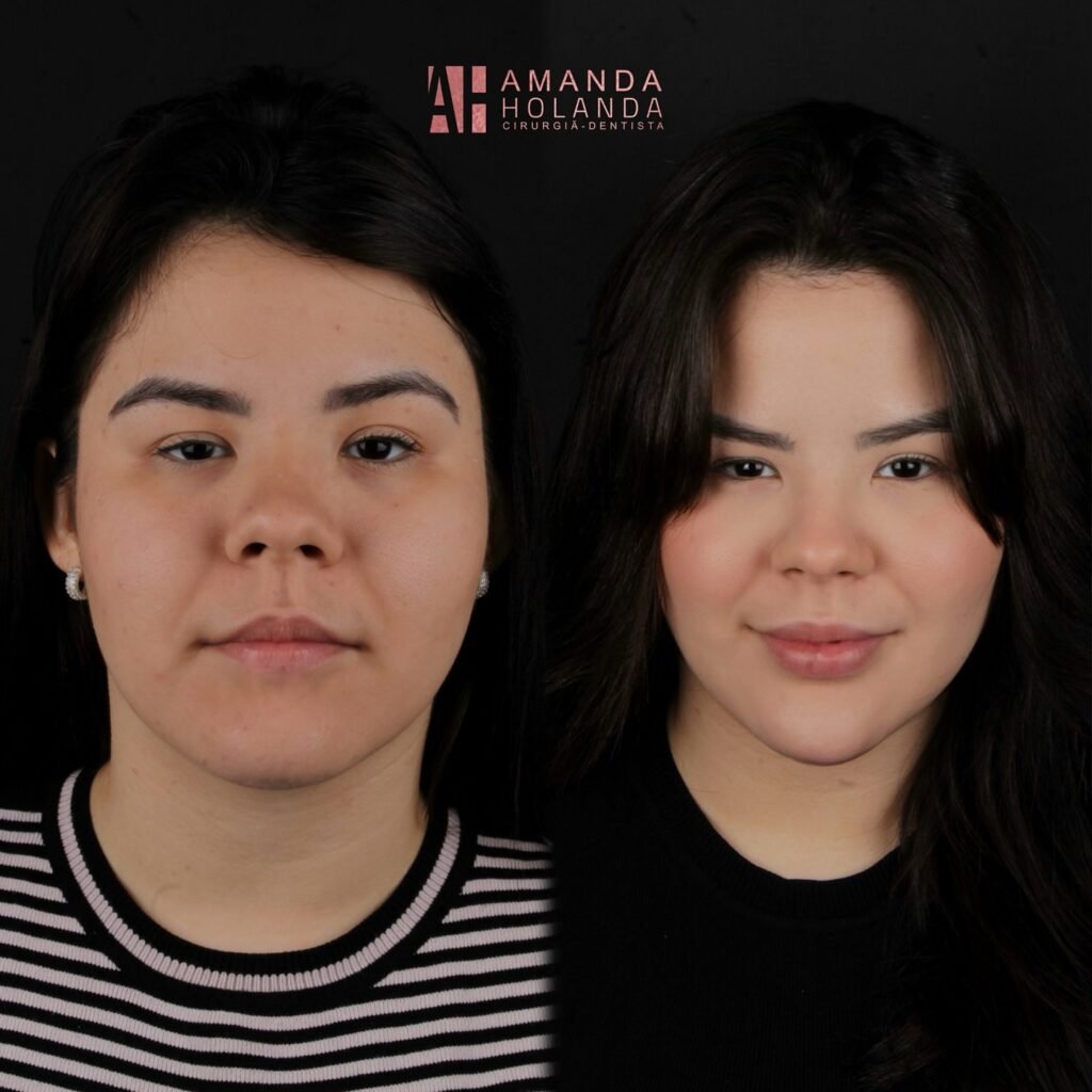 harmonizacao facial em fortaleza dra amanda 01