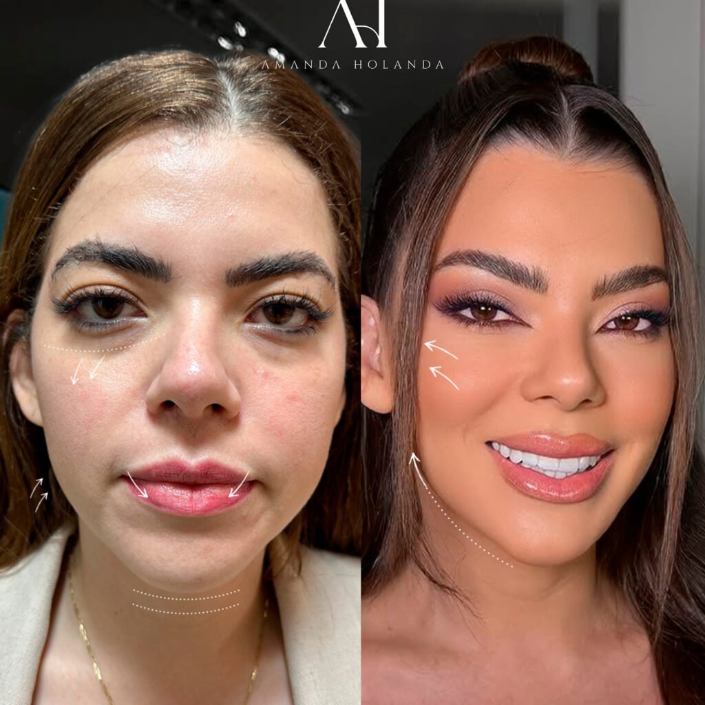 harmonizacao-facial-em-fortaleza-dra-amanda-02