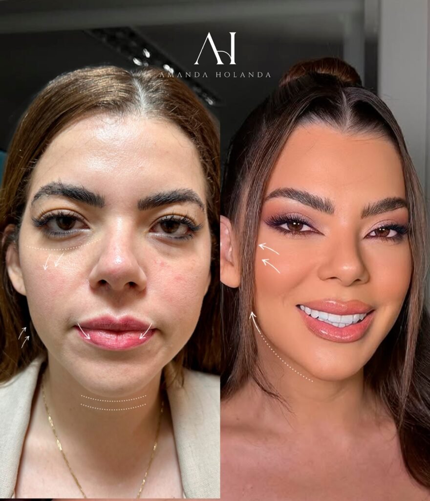 harmonizacao facial em fortaleza dra amanda 02