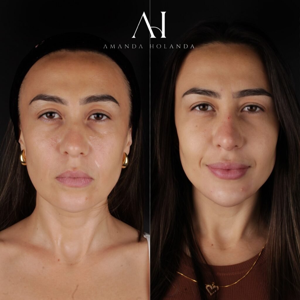 harmonizacao facial em fortaleza dra amanda 03
