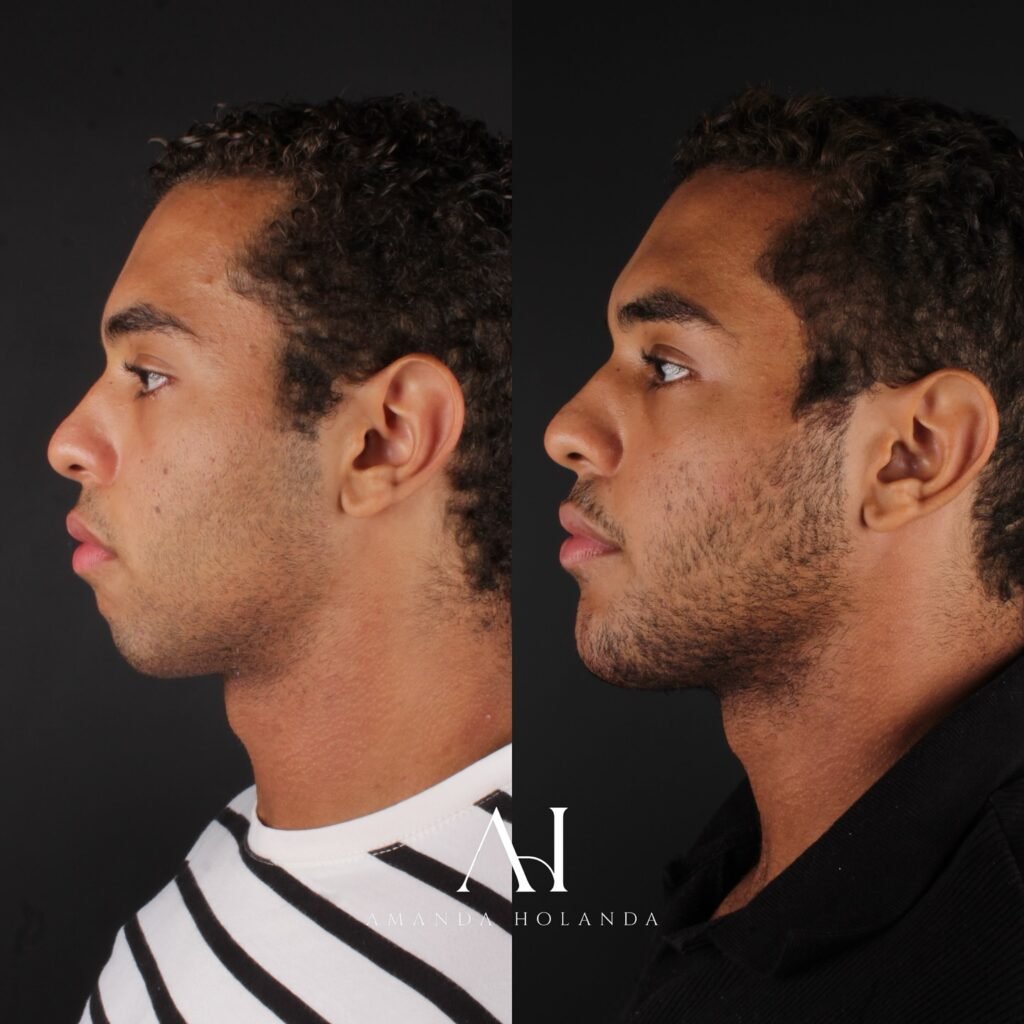 harmonizacao facial em fortaleza dra amanda 05