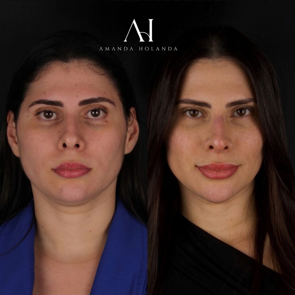 harmonizavcao facial em fortaleza dra amanda 04